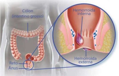 Hemorroida