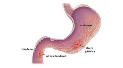 úlcera